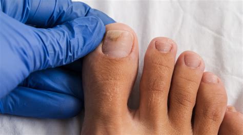 Onychomycosis: A Look Into This Nail Condition - HealthKart