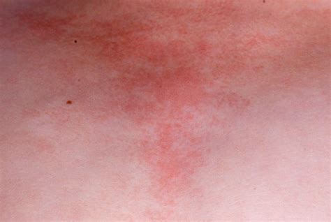 Heliotrope Rash - Pictures, Symptoms, Causes, Treatment