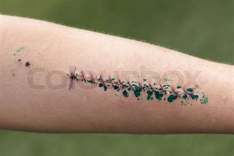 Wound and stitches on forearm | Stock image | Colourbox