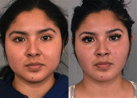 Cheek Liposuction and Permanent Facial Contouring in NYC