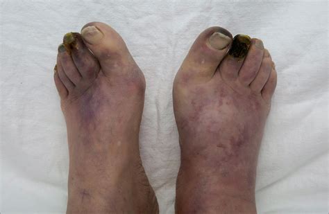 Bilateral Foot Gangrene | Cardiology | JAMA Oncology | JAMA Network