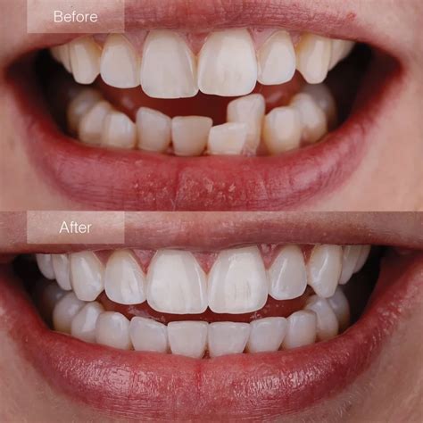 Clear Aligners Orange County | Town Square Family Dentistry