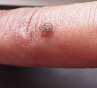 73 Images Of Viral Warts For FREE - MyWeb