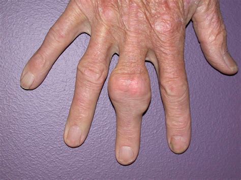 Finding Gout Relief With Supplements