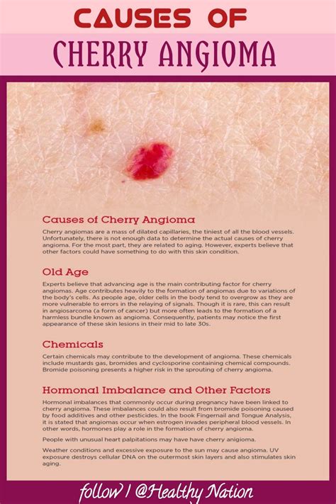 CAUSES OF CHERRY ANGIOMA | Cherry angioma, Natural pain relief, Beauty tips and secrets