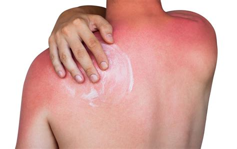 Can Black People Get Sunburn, Quick Facts Sunburn Msd Manual Consumer Version, Its directly ...