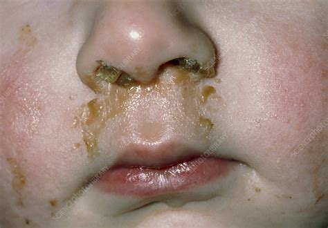Rhinitis: mucus & pus discharge from child's nose - Stock Image - M130/0391 - Science Photo Library