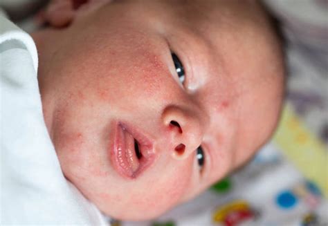 40+ Baby Milia Stock Photos, Pictures & Royalty-Free Images - iStock