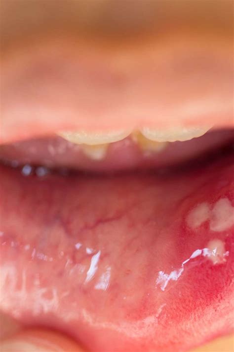 Hpv Bumps In Throat