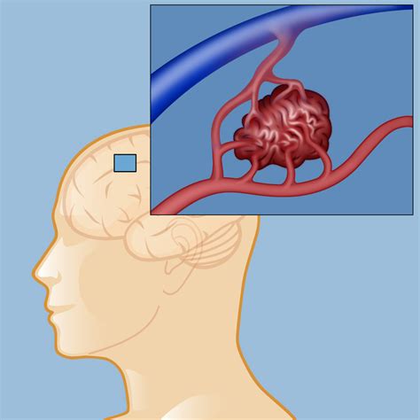 Arteriovenous Malformation (AVM) | Weill Cornell Brain and Spine Center