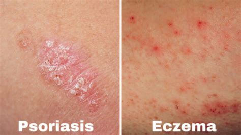 Eczema vs. Psoriasis: What's the Difference? - Dr. Ana-Maria Temple