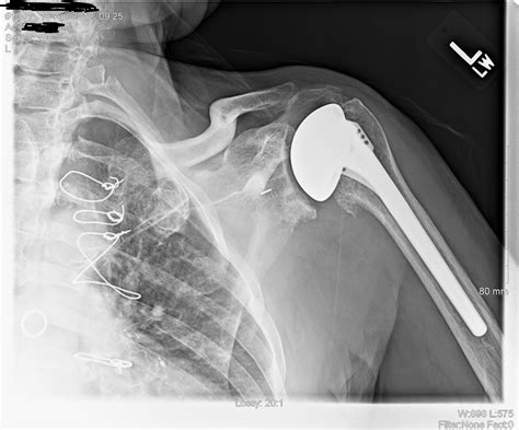 Shoulder and Elbow Surgery: The glenoid component in total shoulder ...