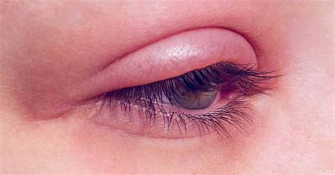 What Are the Signs and Symptoms of a Stye?
