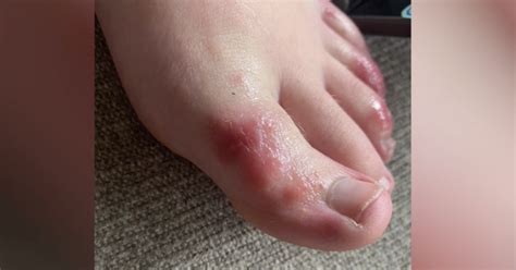 COVID toes: A look at the mysterious rash that can affect patients with coronavirus