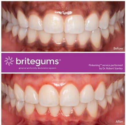 Can I Remove Purple Spots on My Gums? | Stanley Dentistry