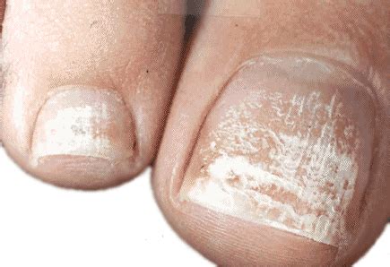 Top 11 Toenail Fungus Natural Treatments Using Home Remedy