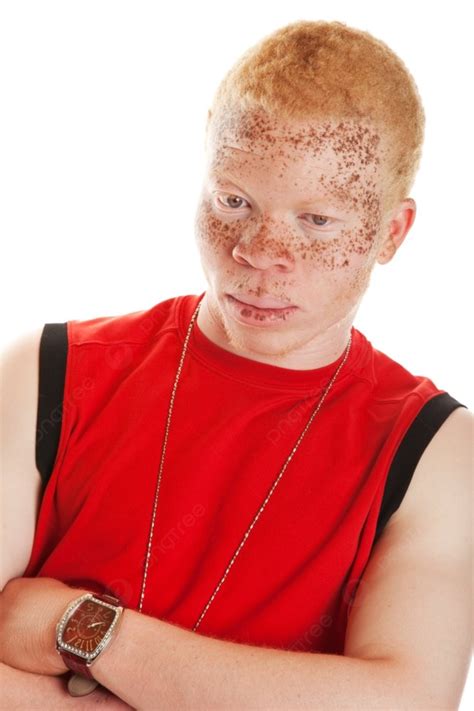 Portrait Of An African Albino Man With Heavily Freckled Lips And Skin ...