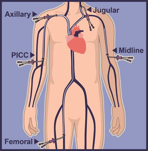 Central Venous Catheter Lines | Vascular Wellness