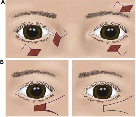 Eyelid defect reconstruction