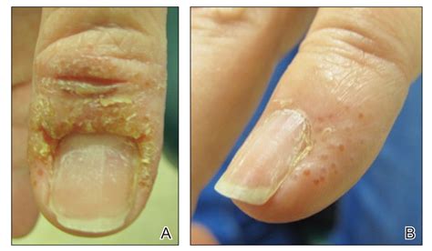 Dyshidroticlike Contact Dermatitis and Paronychia Resulting From a Dip ...