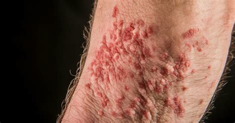 Mold Rash: Causes, Symptoms, And Prevention Tips