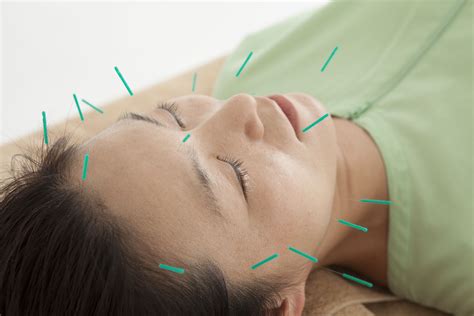 Why Medical Acupuncture Is So Beneficial - Englinton Medical P.C.