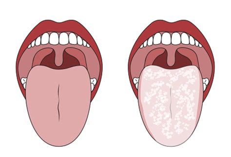 Yeast Infection On Tongue