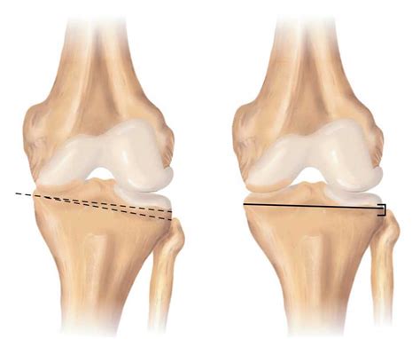 Knee Osteotomy | High Tibial | Tibial Tubercle | Distal Femoral ...