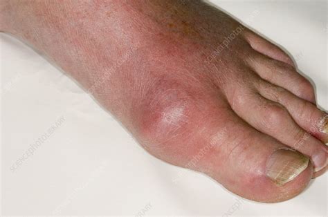 Gout Great Toe | Gout Healer