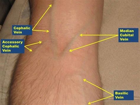 What is a veinpuncture test, Venipuncture