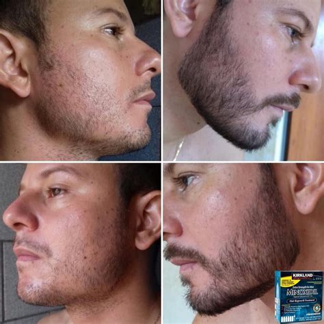 Kirkland Minoxidil Before And After