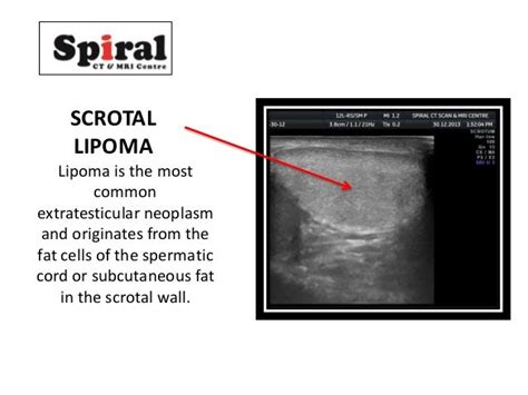 Anterior ectopic anus advanced usg lounge