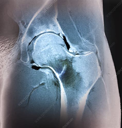 Hip stress fracture, MRI scan - Stock Image - C040/3311 - Science Photo ...