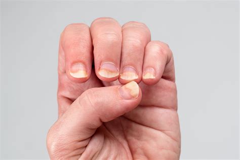 Psoriasis Nails Oil Spot