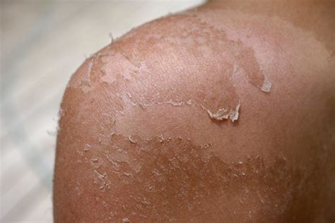 Ask the Expert: What Should I Do if I Get a Blistering Sunburn? - The Skin Cancer Foundation