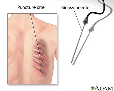 Lung biopsy: MedlinePlus Medical Encyclopedia Image