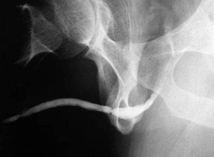 Urethral stricture | Radiology Reference Article | Radiopaedia.org
