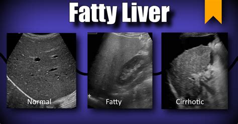 MEDICAL ULTRASOUND /FATTY LIVER