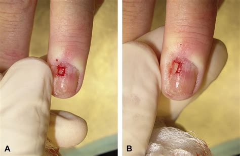 Alternatives to complete nail plate avulsion - Journal of the American Academy of Dermatology