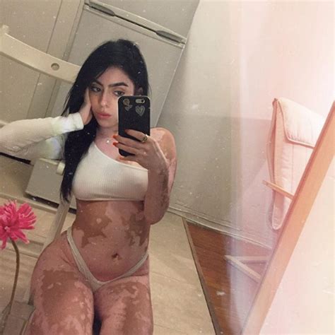 Instagram Model Turns Her Vitiligo Into Body Art – MirraSkincare