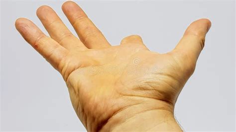 Hand of a Person with a Part of the Index Finger Missing Due To a Prior ...