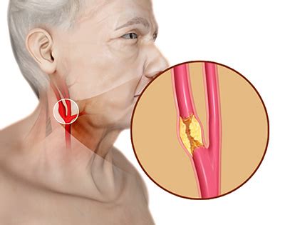 Top 7 how serious is a blocked carotid artery 2022