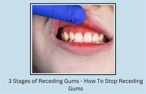 3 Stages of Receding Gums - How To Stop Receding Gums - Oral Health Line