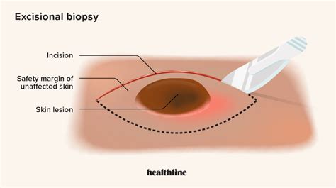 Excisional Biopsy: Purpose, Benefits, Procedure, and More