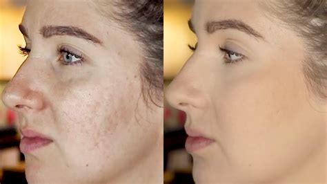 Best Makeup For Pitted Acne Scars | Makeupview.co