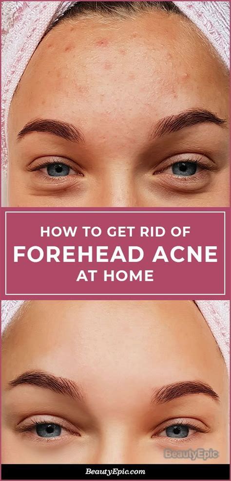 Forehead Acne - Here's How to Treat at Home | Forehead acne, Skin care acne, Face acne