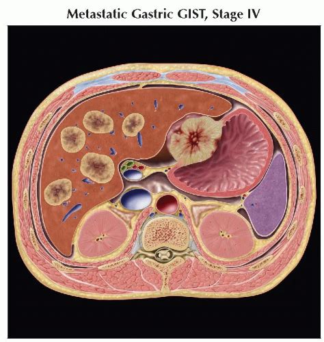 Gastrointestinal Stromal Tumor