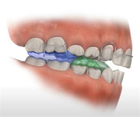 Twin Block and Bionator Functional Appliances - Burke & Redford Orthodontists