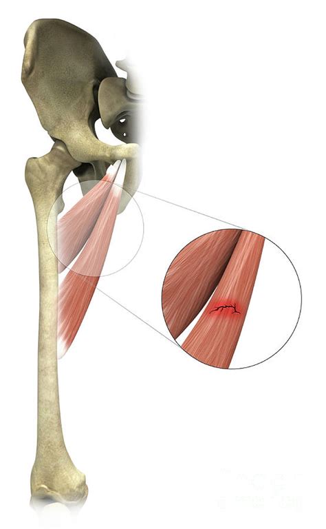 Adductor Muscle Strain Photograph by Medical Graphics/michael Hoffmann/science Photo Library ...