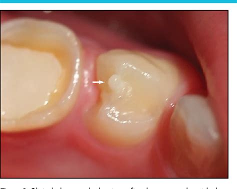 Table 1 from Prevalence of Premolars with Dens Evaginatus in a ...